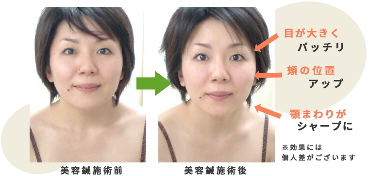 市ヶ谷オレンジ治療院 美容鍼 実績のある当院の美容鍼施術