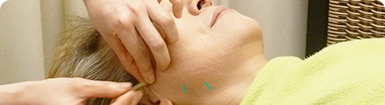 美容鍼